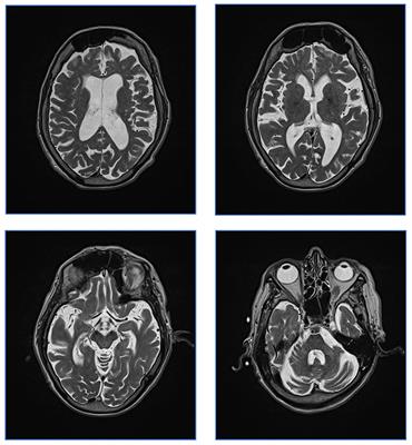 Case report: Huppke–Brendel syndrome in an adult, mistaken for and treated as Wilson disease for 25 years